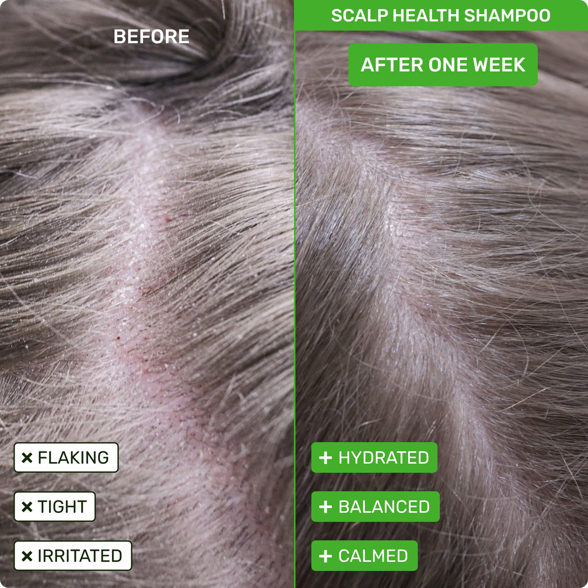 Kormesic 1% Ketoconazole Anti-Dandruff 4-Step Scalp Treatment Kit – Professional Scalp Care System (1kg)